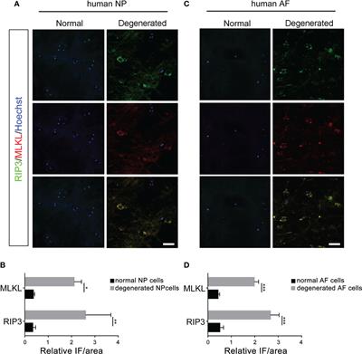 Necroptosis of nucleus pulposus cells involved in intervertebral disc degeneration through MyD88 signaling